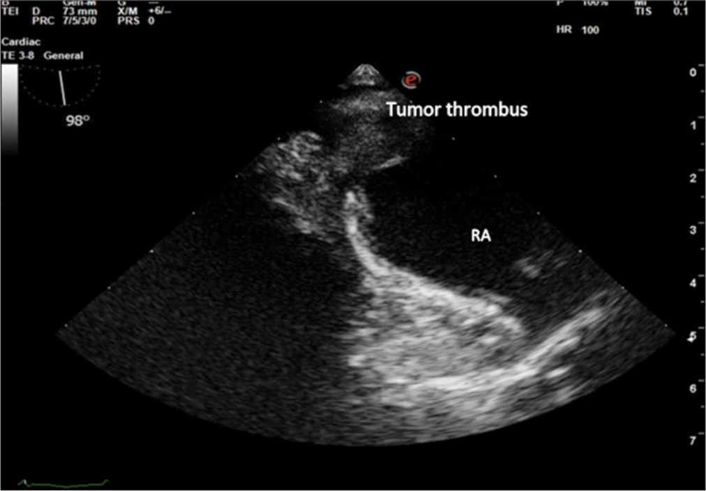 Midesophageal bicaval view to focus opening of inferior vena cava into the right atrium (RA), showing extension of tumor thrombus into RA.