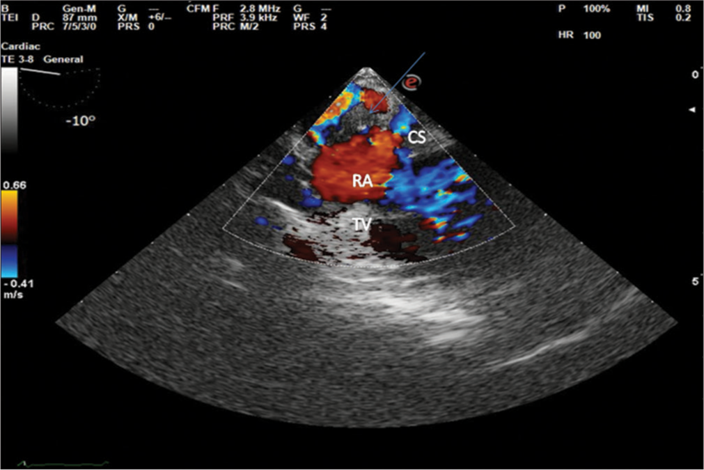 Midesophageal four chamber view showing tumor thrombus (arrow) reaching till coronary sinus.