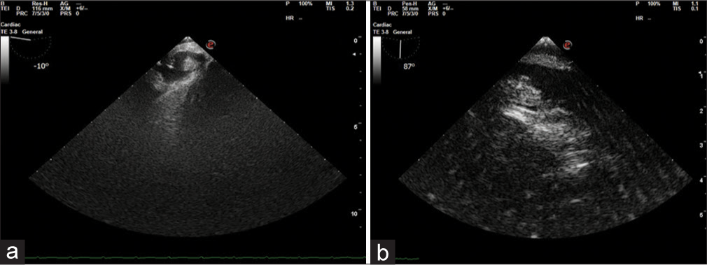 (a) Transgastric (TG) inferior vena cava (IVC) short axis view: Post-thrombectomy shows residual thrombus in the IVC, note the reduced size of residual thrombus. (b) TG IVC long axis with probe withdrawn to right atrium-IVC junction, showing residual thrombus.