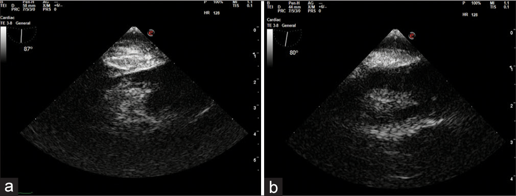 Transgastric inferior vena cava (IVC) long axis view (a and b) showing residual tumor thrombus in intra-hepatic IVC.