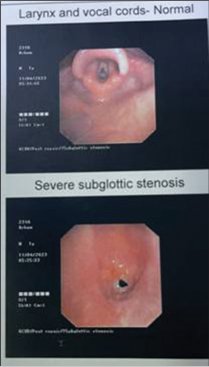 Bronchoscopy views showing normal vocal cord (upper one) and severe membranous subglottic stenosis (lower one).