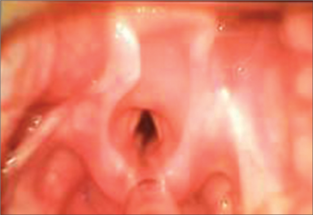 Video laryngoscopy image of vocal cord with endotracheal tube in situ.