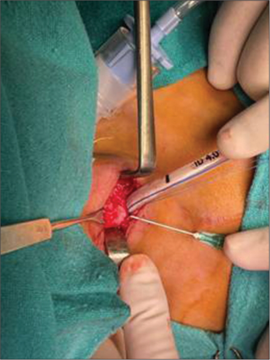 Appropriate size endotracheal tube inserted through tracheotomy site.