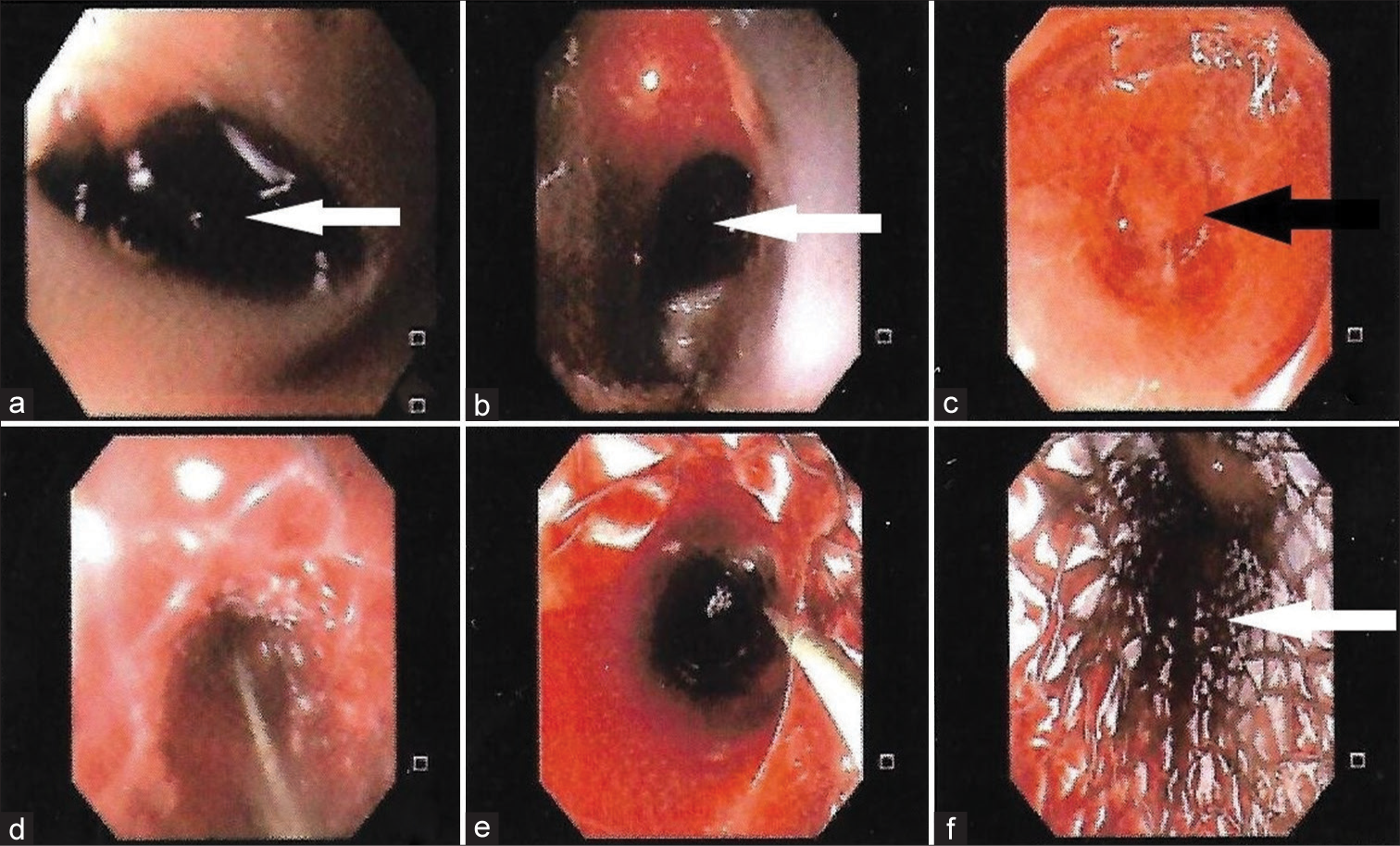 Upper gastrointestinal endoscopy showing (a and b) blood clots in esophagus (white arrows), (c) possible site of tear (black arrow), and (d-f) deployment of covered metal stent in the esophagus (white arrow).