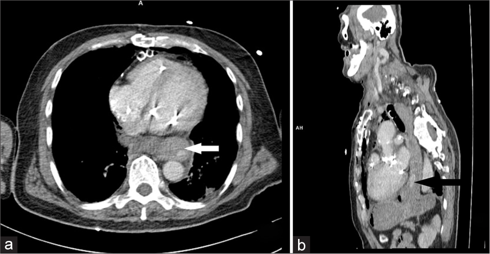Axial and sagittal computed tomography scans of the chest showing (a) dilated esophagus (white arrow) and (b) extravasation of the contrast (black arrow).