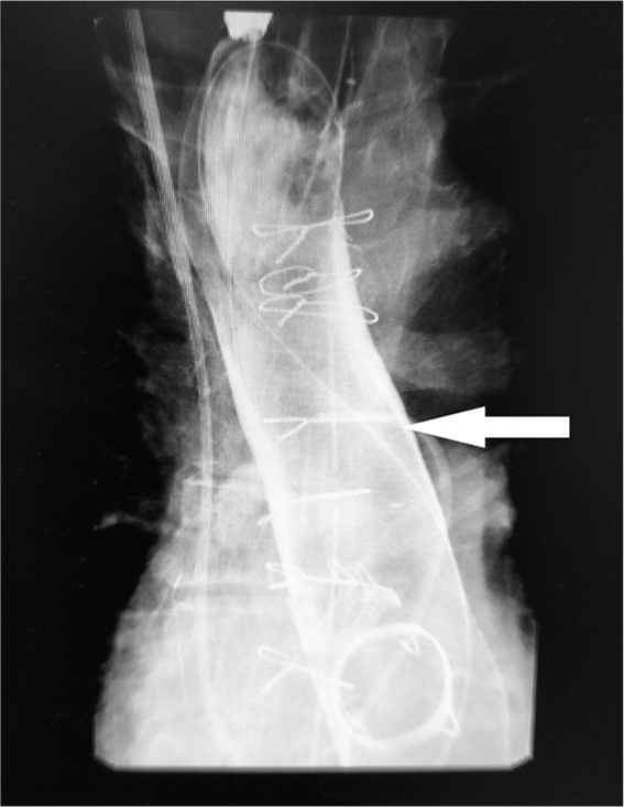 Fluoroscopy image showing deployed stent in the esophagus (arrow).