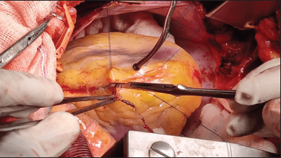 Stent being removed from the left anterior descending along with vessel intima.