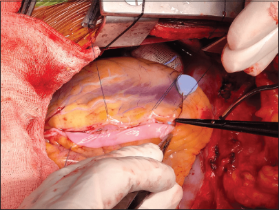 Vein patch being sutured over left anterior descending.