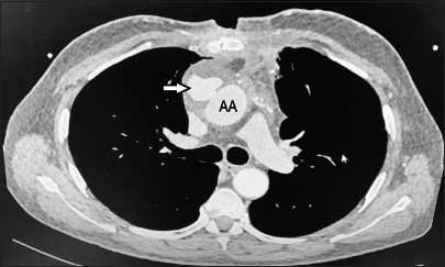 Computed tomography angiography axial section showing a large, saccular pseudoaneurysm (arrow) communicating with the ascending aorta (AA).