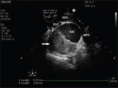 Intraoperative transesophageal echocardiography ascending aorta short-axis view showing aortic pseudoaneurysm filled with blood-clots (arrow) communicating with the ascending aorta (AA). SVC: Superior vena cava, RPA: Right pulmonary artery, MPA: Main pulmonary artery.