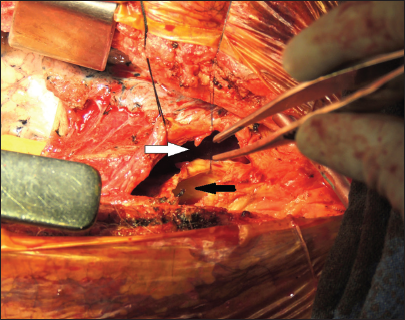 Photograph taken during surgery after removal of the clots from the pseudoaneurysm cavity (white arrow) and opened anterior wall of the ascending aorta (black arrow).