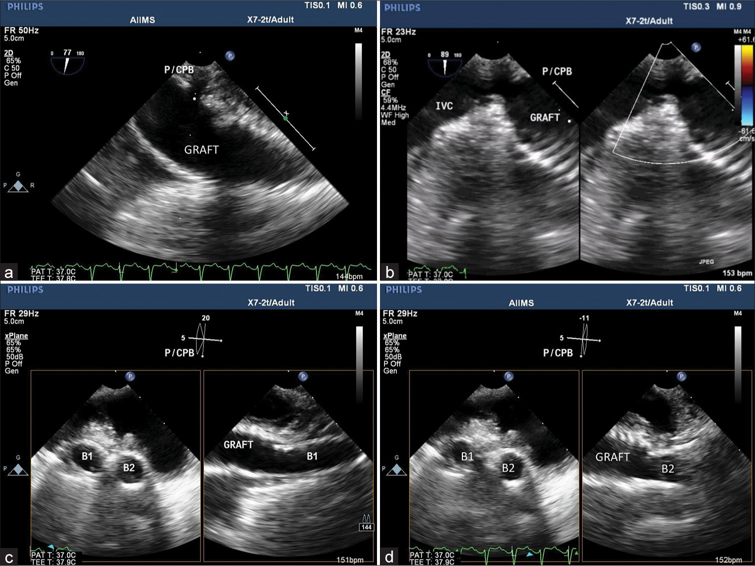 (a) Midesophageal view focusing on the graft illustrates its patency, (b) proximal anastomotic site to supra-hepatic inferior vena cava, and orthogonal image (b1 and b2) showing patent distal anastomotic site of Y graft corresponding to the (c and d) respective pulmonary arteries.