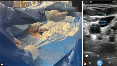 (a) Image of contained ultrasound device on sterile field without wired connection. This image depicts the utilization of a portable handheld device and a cellular phone image display for placing a venous return cannula in a venovenous-extracorporeal membrane oxygenation patient. Asterix: Venous return cannula in VV ECMO. (b) Demonstration of the cellular phone image obtained from the procedure in 3a. Cell phone ultrasound image of the venous ECMO cannula.