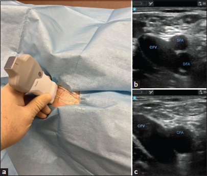 (a) Demonstrating femoral vascular image acquisition. (b and c) Demonstrating imaging obtained on cellular phone display.