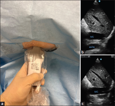 (a) Demonstrating transhepatic view for confirming wire placement. (b and c) Demonstrating transhepatic ultrasound view anatomy.