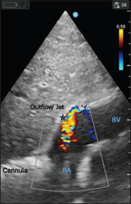 Demonstrating the appropriate positioning of a dual lumen single site veno-venous extracorporeal membrane oxygenation cannula. RA: Right Atrium, RV: Right Ventricle, Asterix: Demonstrating flow of cannula return directed toward tricuspid valve with color flow doppler.