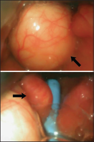 Video-laryngoscopic view of the vallecular cyst and insertion of the bougie past the vallecular cyst (arrows).