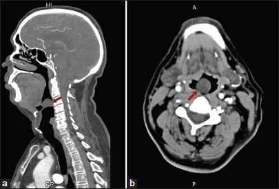 (a) Arrow showing cystic lesion in the vallecula on axial and (b) Sagittal images on computed tomography of head and neck.