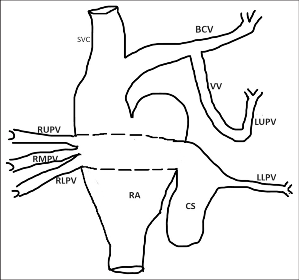 Diagrammatic representation of mixed TAPVD. TAPVD: Total anomalous pulmonary venous drainage, SVC: Superior vena cava, RA: Right atrium, CS: Coronary sinus, RUPV: Right upper pulmonary vein, RMPV: Right middle pulmonary vein, RLPV: Right lower pulmonary vein, LLPV: Left lower pulmonary vein, LUPV: Left upper pulmonary vein, VV: Vertical vein, BCV: Brachiocephalic vein.