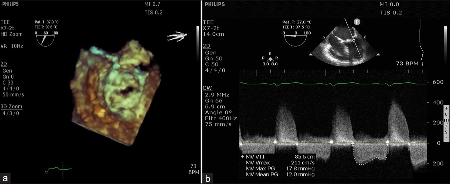 (a) Three-dimensional en-face view of the mitral valve shows restricted opening and (b) continuous-wave Doppler at mitral valve shows severe mitral stenosis.