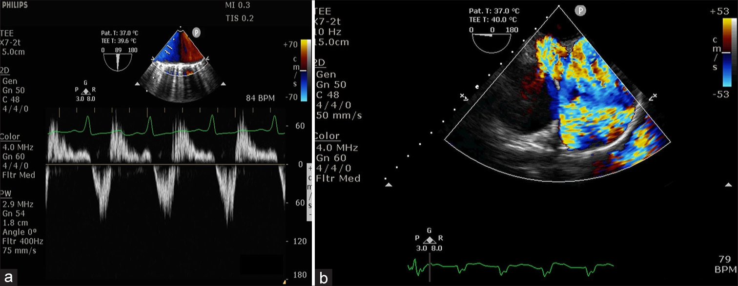 (a) Pulse-wave Doppler at aortic arch shows diastolic flow reversal and (b) upper-esophageal ascending aorta short-axis view shows free pulmonary regurgitation.