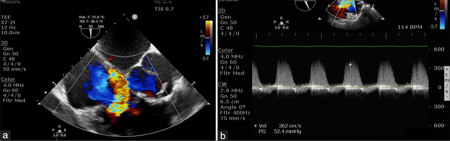 (a) Color flow Doppler at tricuspid valve shows severe regurgitation, (b) modified bicaval view shows tricuspid regurgitation jet.