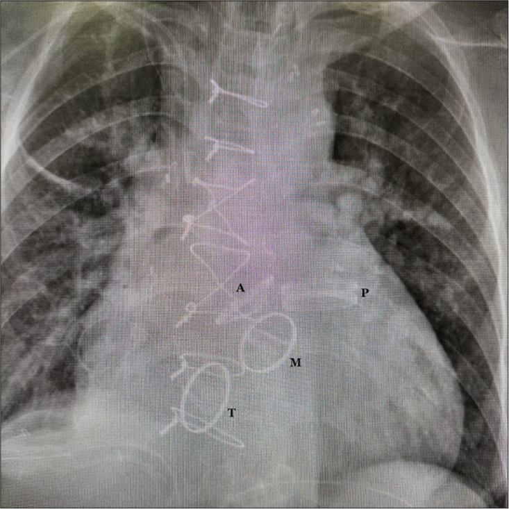 Post-operative chest radiograph shows all four valves, P: Pulmonary, A: Aortic, M: Mitral, T: Tricuspid.