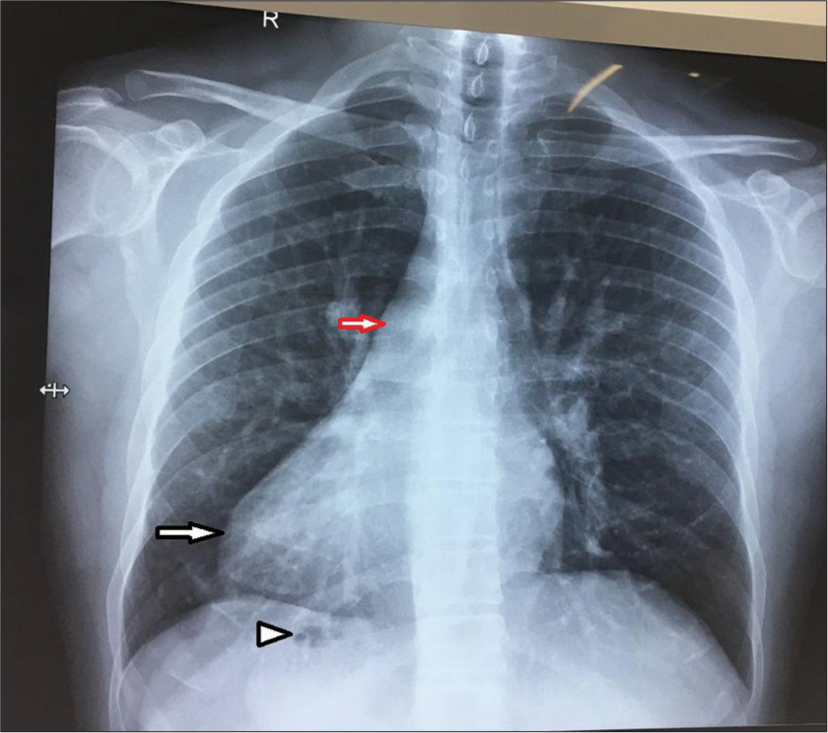 Chest radiograph showing dextrocardia (black arrow), right aortic arch (red arrow), and gastric bubble on the right side (arrow head).