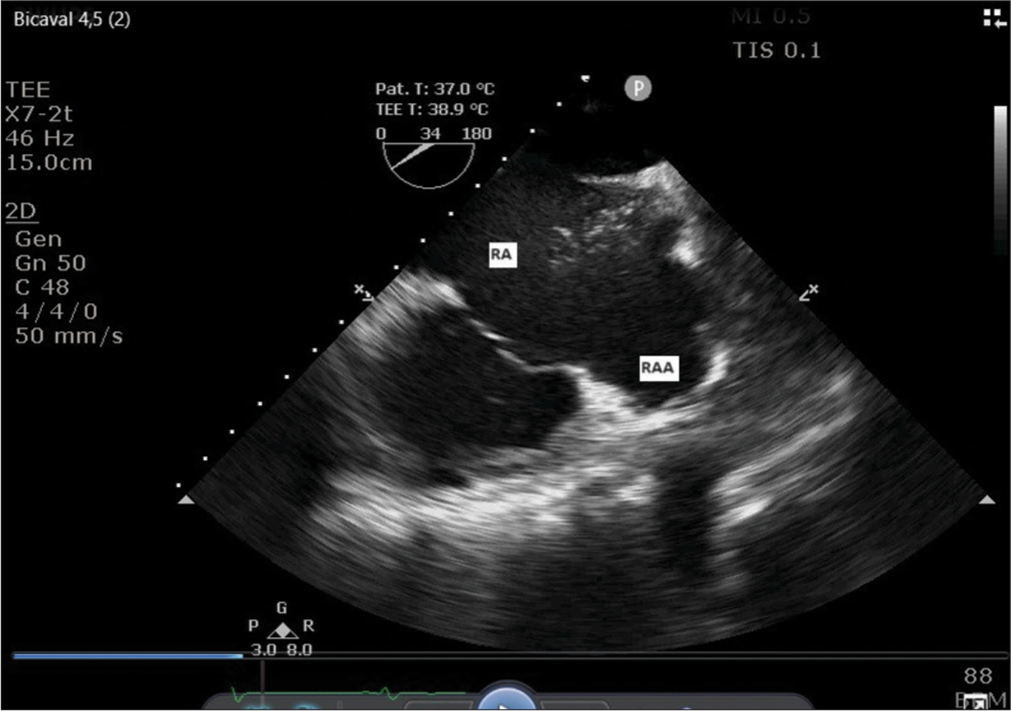 Midesophageal modified bicaval view showing right atrium with agitated saline appearing in it through superior vena cava, and broad-based right atrial appendage.