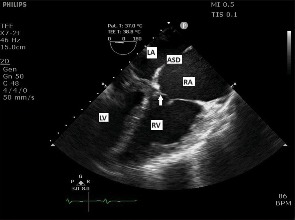 Midesophageal four-chamber view showing left atrium (LA) and left ventricle (LV) on the left side of display. Right atrium (RA), right ventricle (RV), and apically placed tricuspid valve (arrow) are seen on the right side. ASD: Atrial septal defect.