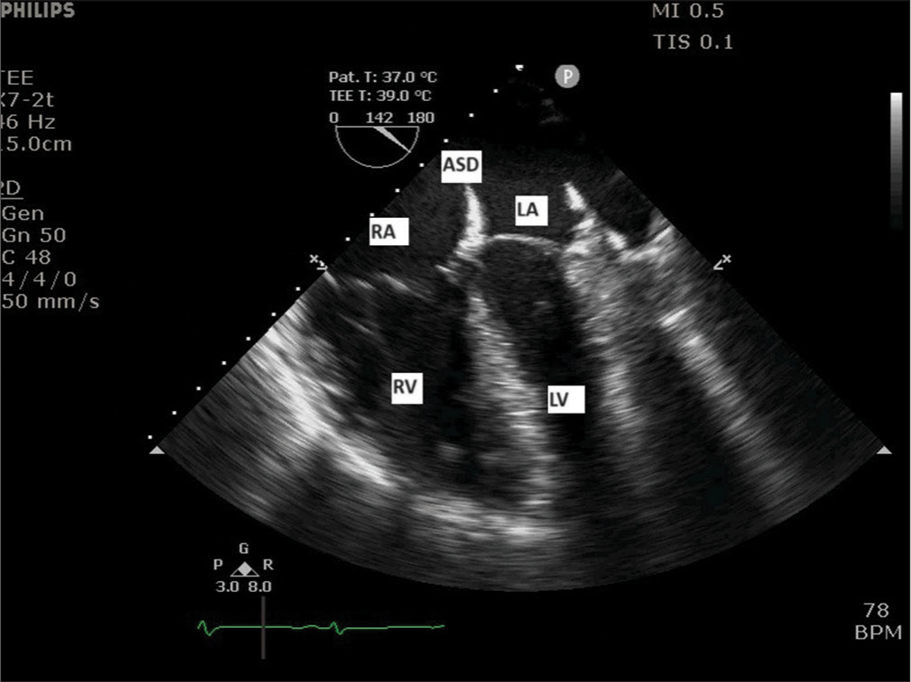 Mirror-image mid-esophageal four-chamber view showing left atrium (LA), left ventricle (LV) on the right side and right atrium (RA), and right ventricle (RV) on the left side of the display. ASD: Atrial septal defect.