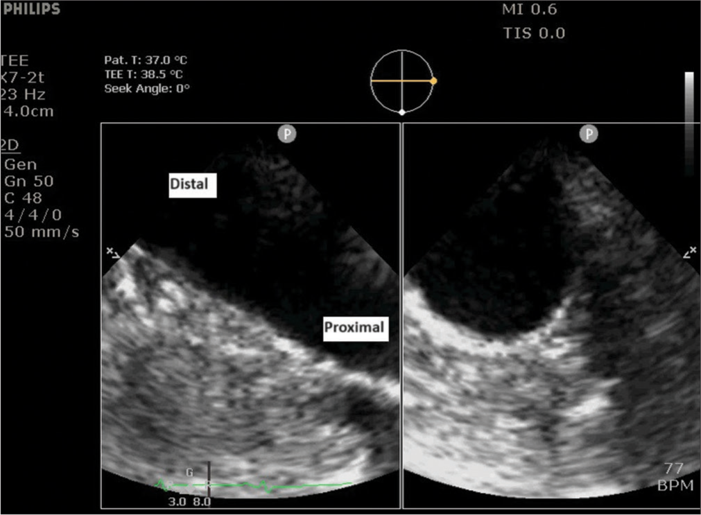 Upper esophageal aortic arch long-axis X-plane view showing right aortic arch traversing from the right in the far-field (proximal) to the left in the near-field (distal arch).