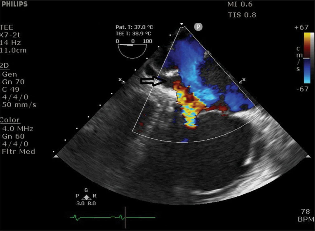 Midesophageal four-chamber view, showing long axis of coronary sinus (arrow) coursing from the right side to the left side.