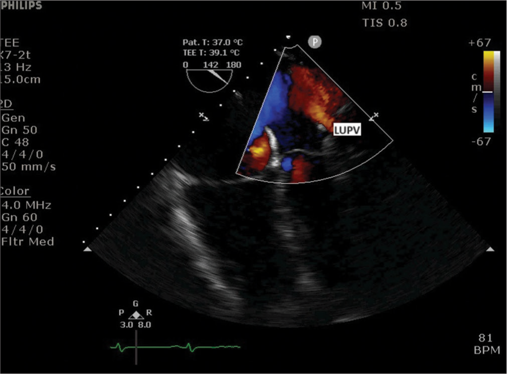 Upper esophageal view showing left upper pulmonary vein (LUPV).