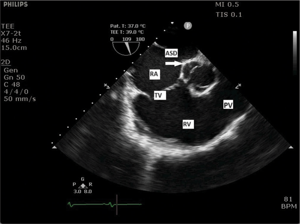 Midesophageal right ventricle inflow-outflow view showing right atrium (RA), tricuspid valve (TV), right ventricle (RV), and pulmonary valve (PV). Atrial septal defect (ASD) with deficient aortic rim is also seen (arrow).