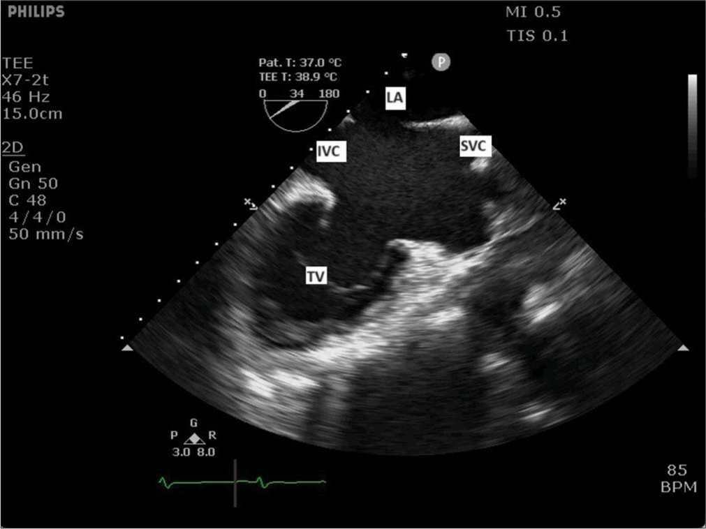 Midesophageal modified bicaval view showing superior vena cava (SVC), inferior vena cava (IVC), tricuspid valve (TV), and left atrium (LA).