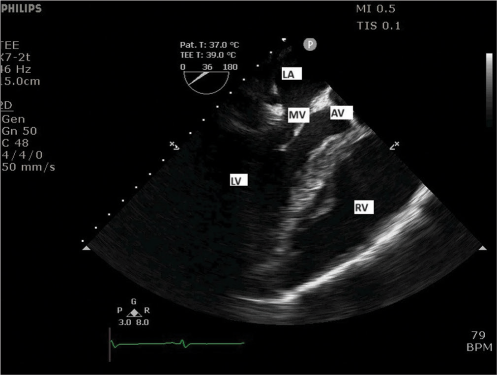 Midesophageal long-axis view (at 36° angle) showing left atrium (LA), mitral valve (MV), left ventricle (LV), aortic valve (AV), and right ventricle (RV).