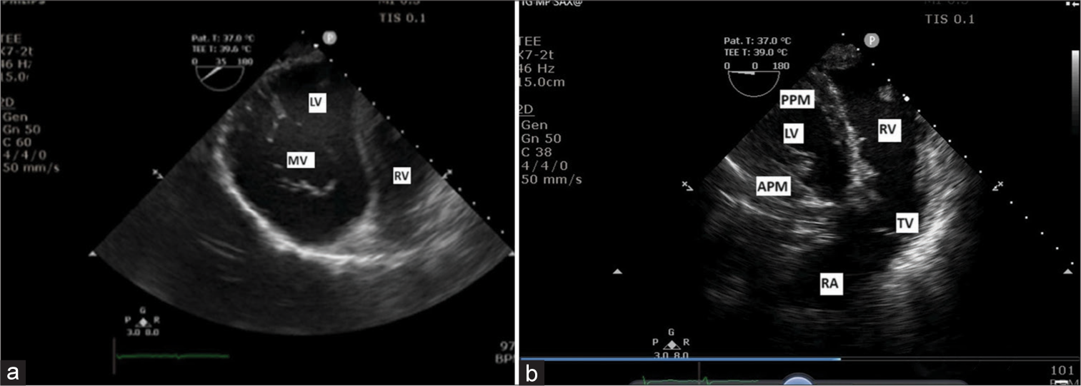 (a) Transgastric (TG) basal short-axis view showing mitral valve (MV), left ventricle (LV) on the left side, and right ventricle (RV) on the right side. (b) TG midpapillary short-axis view showing anterior papillary muscle (APM), posterior papillary muscle (PPM), LV on the left side with right atrium (RA), tricuspid valve (TV), and RV on the right side.