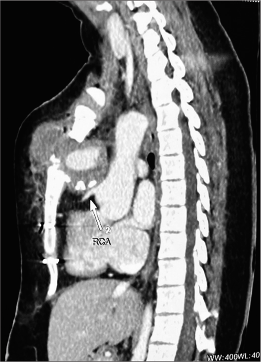 Computer tomography scan of the patient demonstrating a pseudoaneurysm of the ascending aorta, its relation with other mediastinal structures, and erosion through a portion of the sternum. The white arrow pointing towards the Right Coronary Artery (RCA) and its proximity to sternum can be noted.