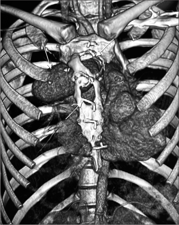 3D rendered reconstruction image showing the defect in sternum due erosion by the pseudoaneurysm arising from ascending aorta. The white arrows point the bony defects due to erosion by the growth of psuedoaneurysm