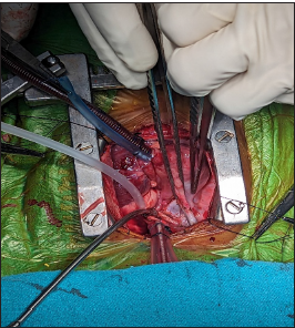 External anatomy of the heart showing small right pulmonary artery.