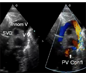 Transthoracic echocardiography of the supracardiac total anomalous pulmonary venous connection showing the superior vena cava and innominate vein with confluent pulmonary valve. PV: Pulmonary vein, SVC: Superior vena cava