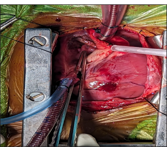 Common chamber formed by the confluence of all four pulmonary veins was seen posterior to the left atrium.