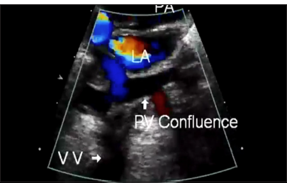 Trans-thoracic echocardiography of intracardiac total anomalous pulmonary venous connection: Pulmonary venous confluence, seen posterior to the left atrium. PV: Pulmonary vein, LA: Left atrium, PA: Pulmonary artery